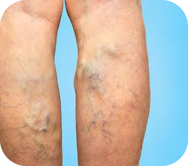 Varicose Veins